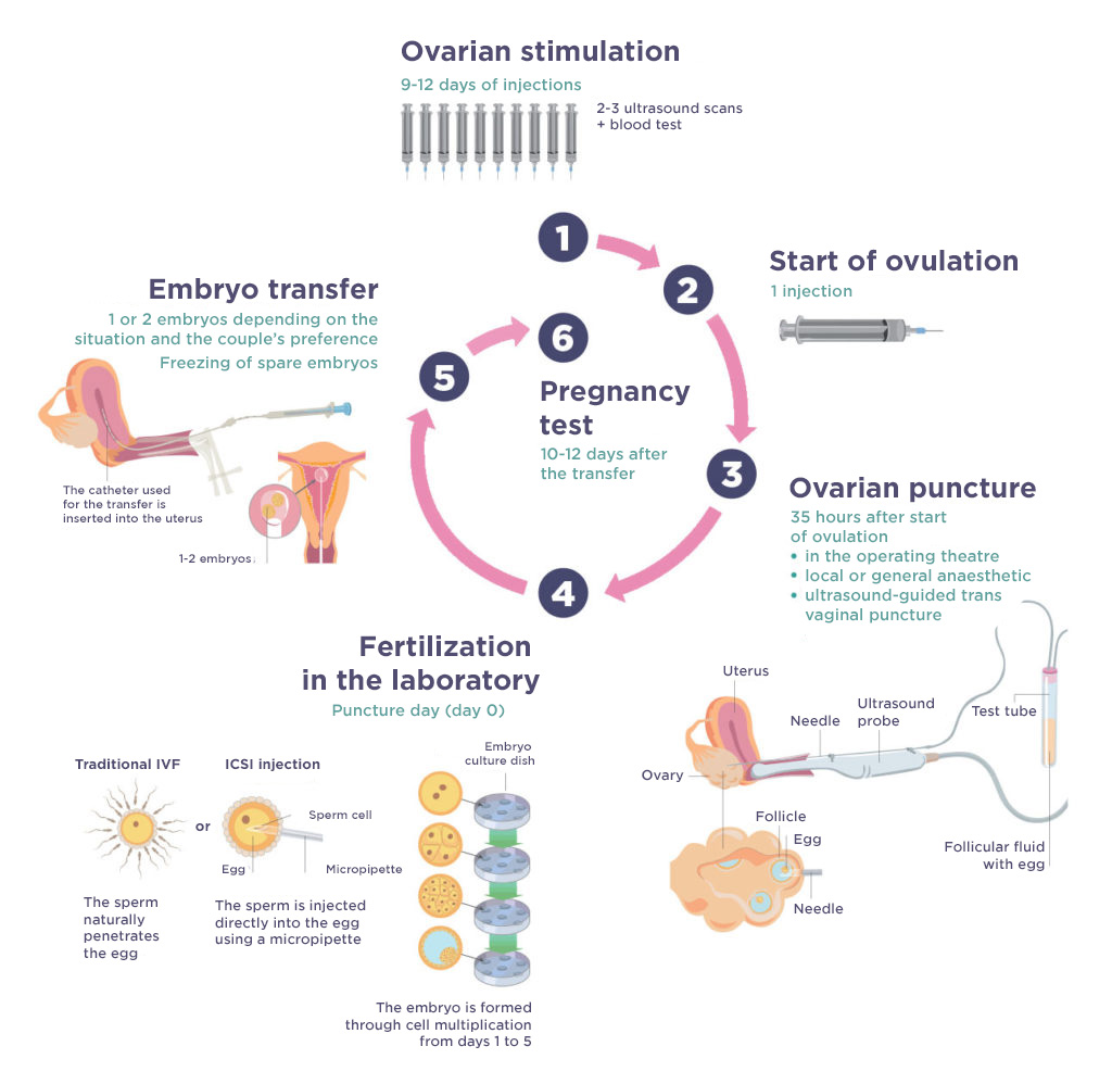 In vitro fertilization process